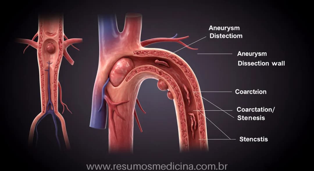 Doenças da Aorta: Guia Completo sobre Dissecção, Coarctação, Estenose e ...