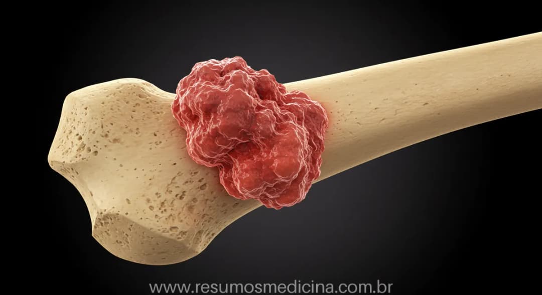 Tumores Ósseos: Guia Completo sobre Tipos, Osteossarcoma e Metástases ...